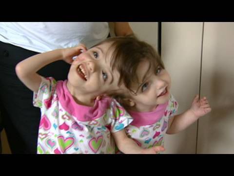 Conjoined Twins: Twin Girls, A Medical Wonder