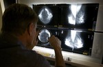 In this photo taken on Thursday, May. 6, 2010, Medical Director Radiologist, Dr. Gerald Iba, checks mammograms, an advanced imaging screening that promotes early detection of breast cancer, at The Elizabeth Center for Cancer Detection in Los Angeles. The financially-strapped California Department of Public Health temporarily banned new enrollments to the Every Women Counts program from Jan. until July 1. But it also upped the age to qualify for the program from 40 to 50. The changes are intended to reduce the number of mammogram recipients to 259,000 this fiscal year from last year's 311,000.