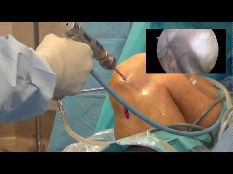 Arthroscopic ACL Reconstruction (Detailed)