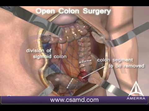 Colorectal Cancer Surgery 3D Medical Animation - Open Procedure