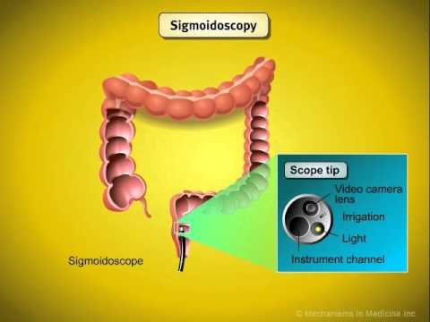 Colorectal Cancer Screening