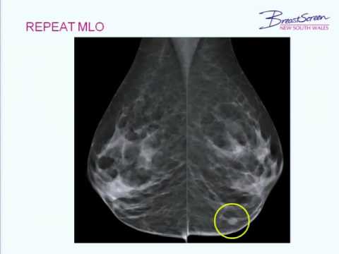 Basic positioning in mammography