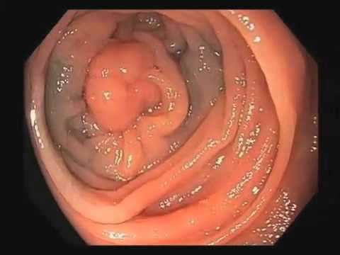 Colonoscopy Video Tour: Discovery of a Cancerous Polyp (Colon Cancer)