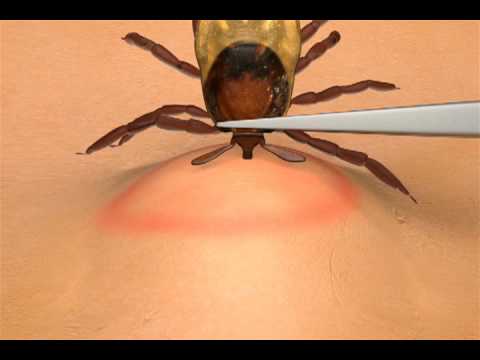 How To Remove A Tick