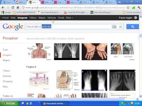 Auto-hemoterapia oral na artrite reumatóide. [Extraído da IndMED]