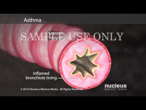 Asthma