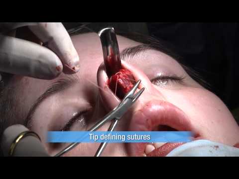 Nose Job - Rhinoplasty and Deviated Septum Surgery