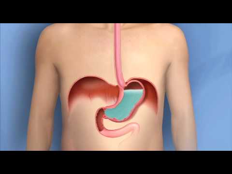 Heartburn, Acid Reflux, GERD-Mayo Clinic