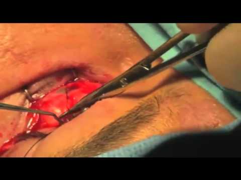 Enucleation: Human Eye Removed by Surgerey