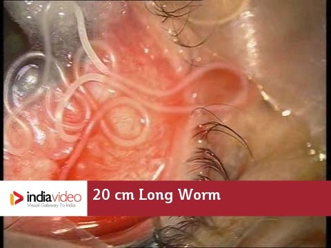 20 cm long worm in the human eye, first ever recorded on video