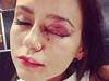 Woman says almost blinded by vicious 'stiletto...