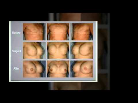 A Guide to Breast Reconstruction - Plastic Surgery