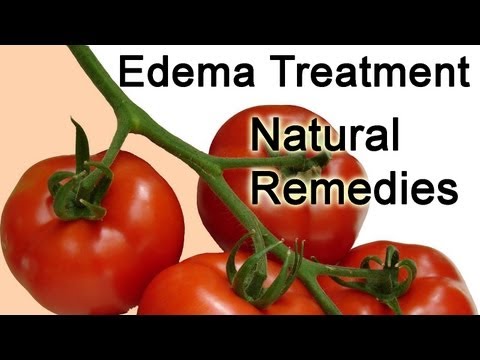 Edema Treatment tips - Edema Treatment Natural Remedies