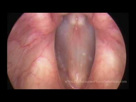 Video Stroboscopy of Vocal Cords