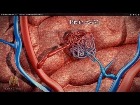 3D Medical Animation (HD) - Arteriovenous Malformation (Brain AVM)