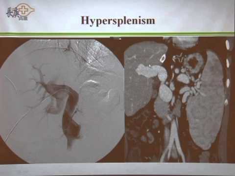 Portal venous complications in living donor liver transplant [ACAR2013TAIWAN]