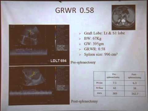 Portal dynamic in living donor liver transplant [ACAR2013TAIWAN]