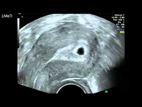 Early pregnancy scan - ultrasound 5 weeks gestation