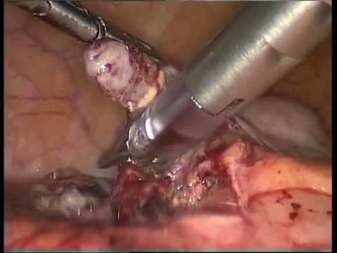 My Appendix Appendectomy Operation by Dr. Alexandros Iagmour