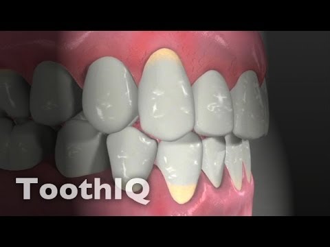 Gingival Recession