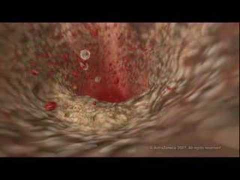 MEDICAL - How cholesterol clogs your arteries (atherosclerosis)