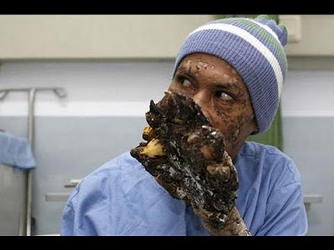 Treeman: The Cure - Extraordinary People - Documentary