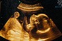 baby scan