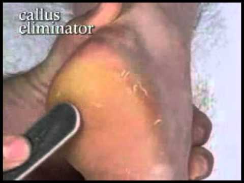 Prolinc - Callus Eliminator