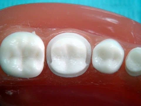 Metal ceramic crown preparation 