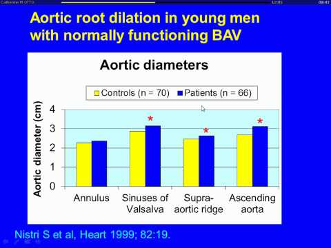 Bicuspid aortic valve: Prevalence, genetics and natural history.