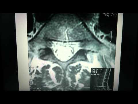 How to Read a Lumbar MRI