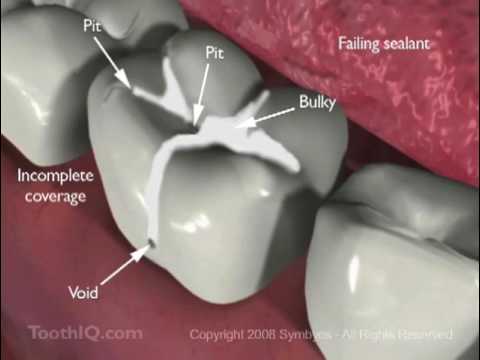 Dental Sealants and Fissurotomy