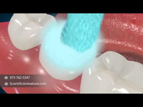 Dental Sealants - Tooth Decay Treatment