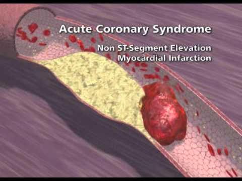 Overview of Coronary Artery Disease