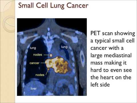 Small Cell Lung Cancer