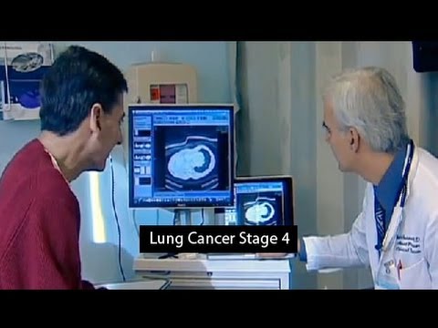 Lung Cancer Stage 4 - Dr. Balazs Halmos