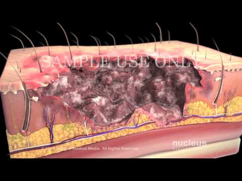 Burns: Classification and Treatment