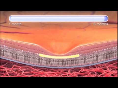 Age-Related Macular Degeneration