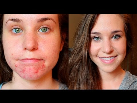 Acne Foundation Routine Full Coverage (The BEST Foundation for Acne, ALL Drugstore Makeup)