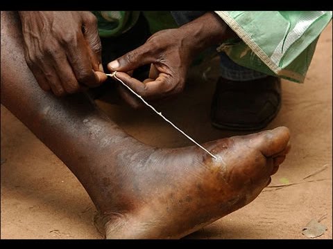 Deadly Human Parasite - Guinea Worm