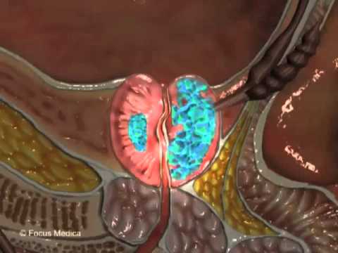 Prostate Cancer (Understanding Disease: Infectious Diseases & Oncology)