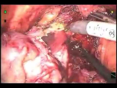 PROSTATE CANCER VIDEO   