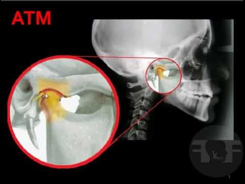 Atm Odontologia Articulación Temporomandibular