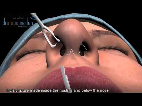 Rhinoplasty Nose Surgery Animation - Dr. Steve Merten in Sydney, Australia