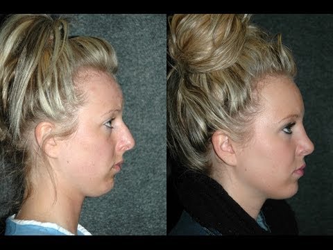 Rhinoplasty Before and After 24 Year Old Women   Experience and Review of Dr Andrew Jacono