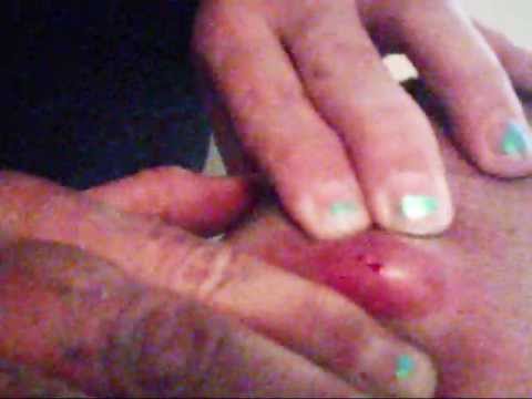 Ryan's Cyst