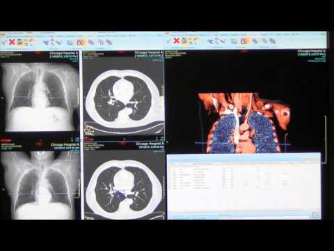 Carestream Lesion Management Demo for Vue PACS v11.4