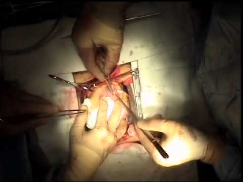 Coronary Bypass Surgery - MedStar Union Memorial