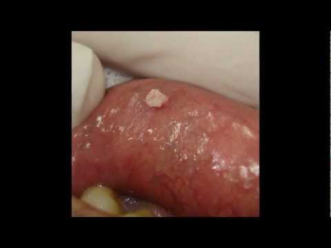 HPV  Papiloma Vírus Humano