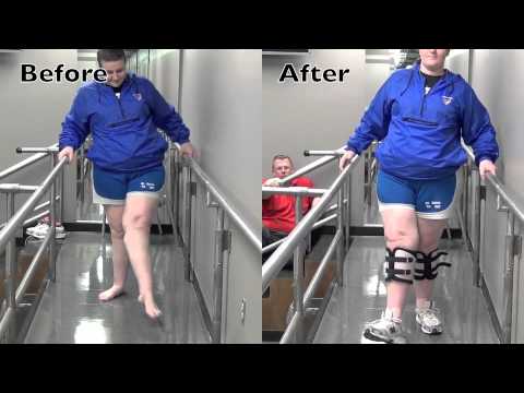 Transverse Myelitis Before and After